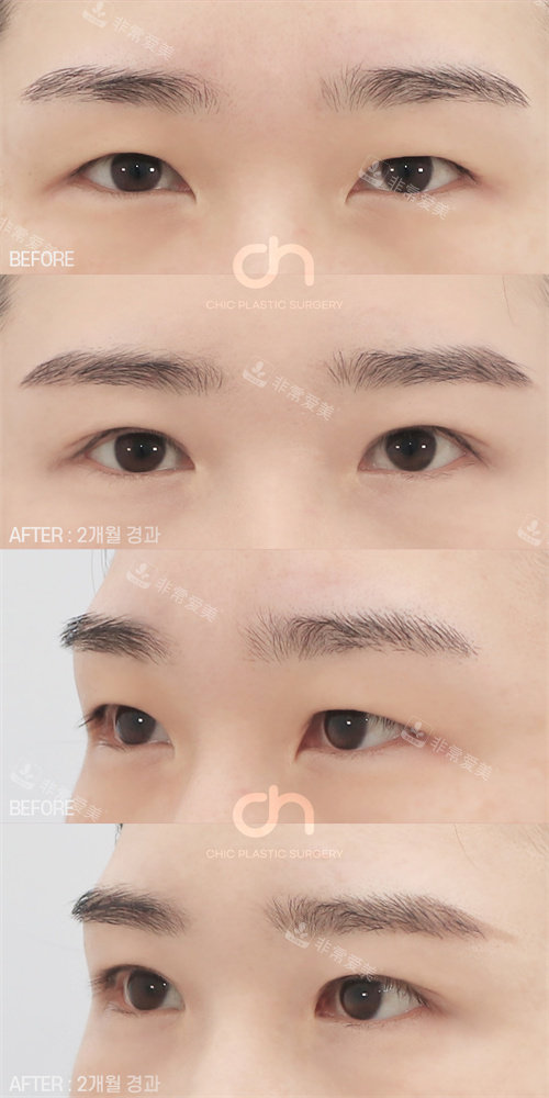 韩国喜可整形双眼皮+开内眼角手术对比图