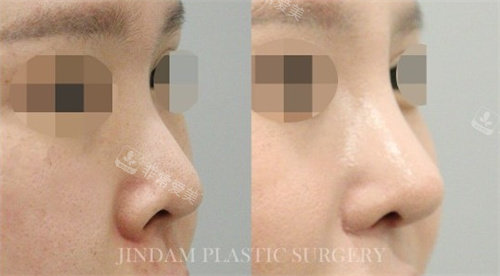 韩国真谈整形隆鼻术前术后对比图