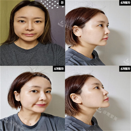 韩国N-Slim医院吸脂+脂肪填充手术对比图