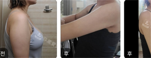 韩国N-Slim医院手臂吸脂术对比图