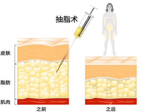 吸脂前后脂肪層變化圖 吸脂前后脂肪層變化圖