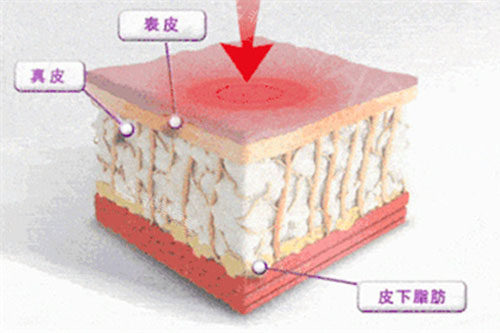 热玛吉工作原理展示图