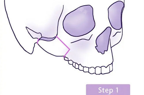 面部颧骨位置说明图