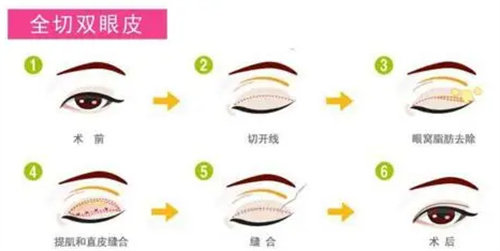 雙眼皮手術操作方法圖 雙眼皮手術操作方法圖
