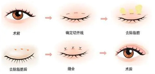 全切雙眼皮流程圖 全切雙眼皮流程圖