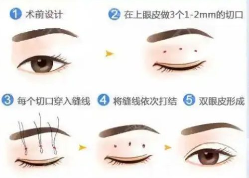 雙眼皮過程示意圖 雙眼皮過程示意圖