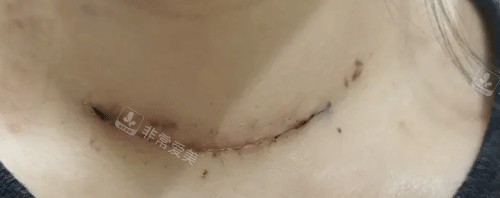 疤痕照片 疤痕照片