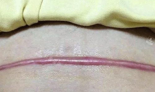剖腹產(chǎn)疤痕照片 剖腹產(chǎn)疤痕照片