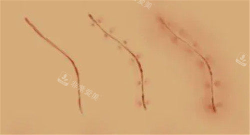 疤痕變化動(dòng)畫(huà)圖 疤痕變化動(dòng)畫(huà)圖