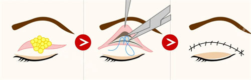 全切双眼皮流程图