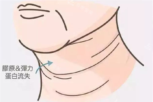 颈纹动画展示图