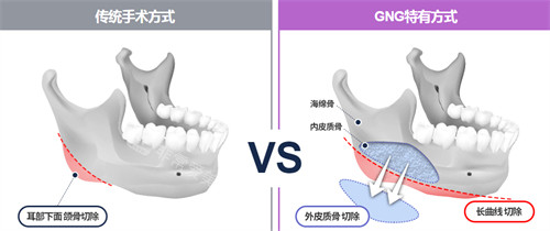 韩国GNG整形医院磨骨方式展示