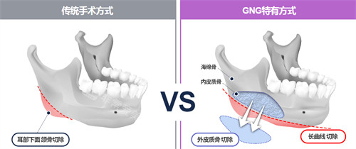 韓國(guó)GNG整形醫(yī)院磨骨方式展示