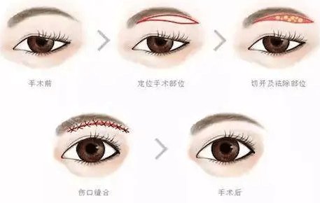 提眉手術(shù)細(xì)節(jié)圖