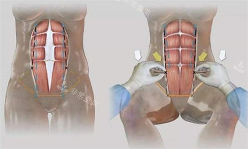 腹直肌修复缝合方法图