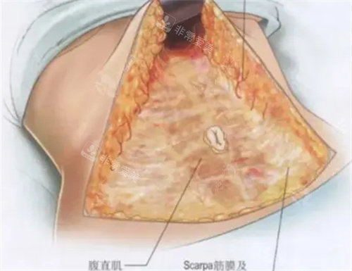 腹壁成形术手术流程图
