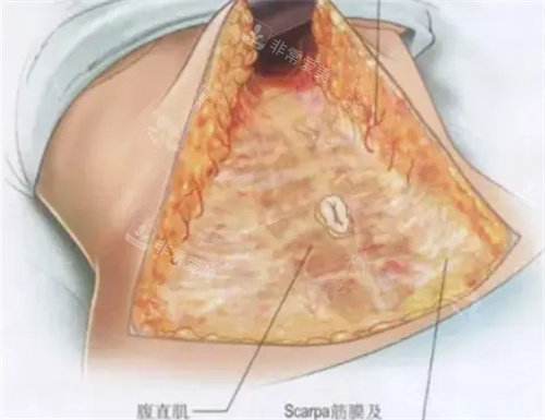腹壁成形術(shù)手術(shù)流程圖 腹壁成形術(shù)手術(shù)流程圖