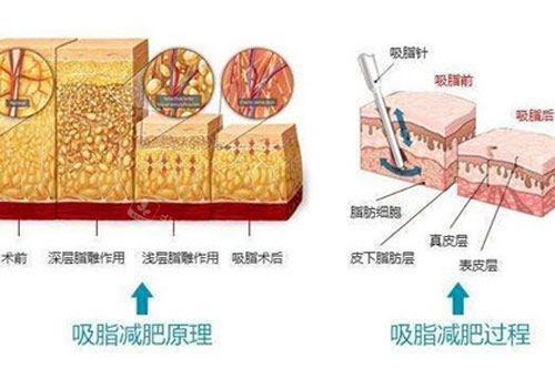 吸脂原理示意图