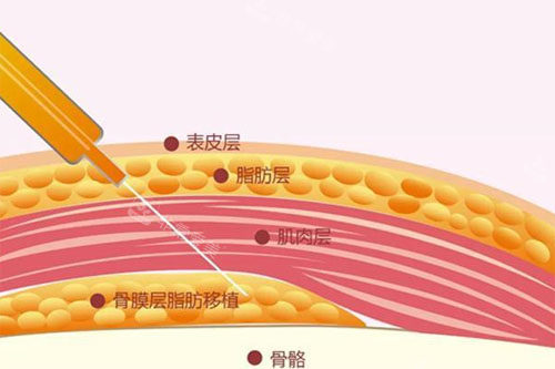 脂肪填充原理展示图