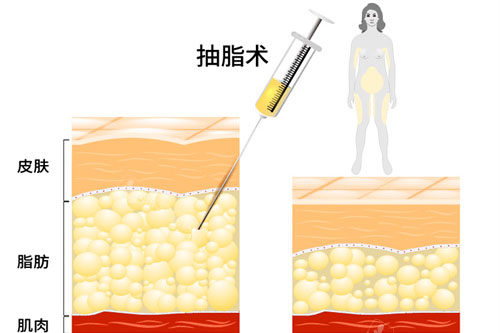 抽脂术原理展示图