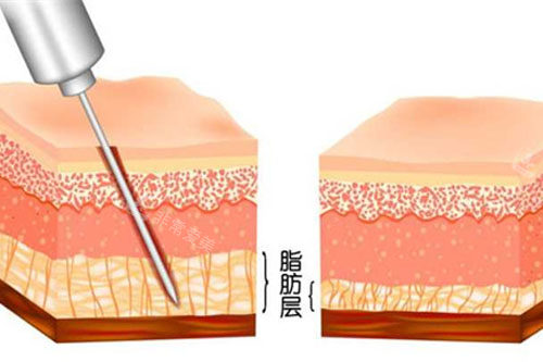 吸脂前后脂肪层变化图