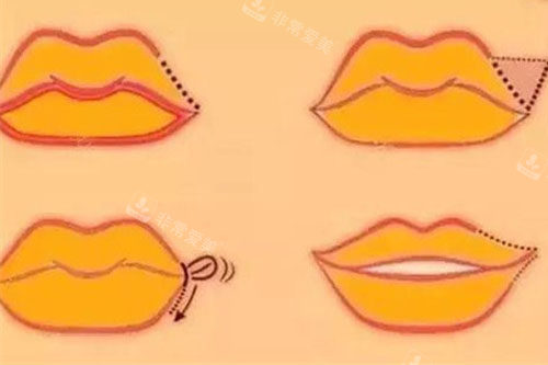 M唇手术流程图