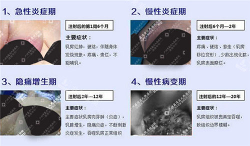 非法注射物不同时期展示图 非法注射物不同时期展示图