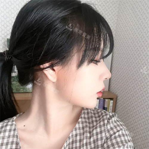 手術(shù)5個(gè)月照片