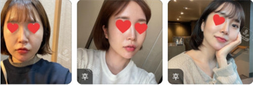 面部吸脂前后對比圖分享 面部吸脂前后對比圖分享