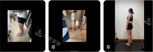 腿部吸脂前后對比圖 腿部吸脂前后對比圖