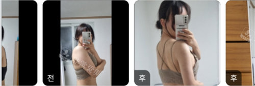 吸脂前后對比照 吸脂前后對比照