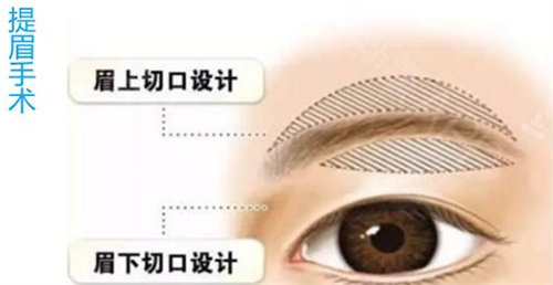 提眉手术 提眉手术