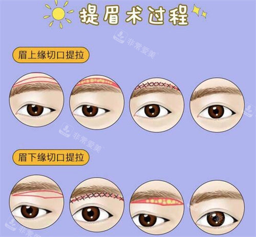 提眉术过程图 提眉术过程图