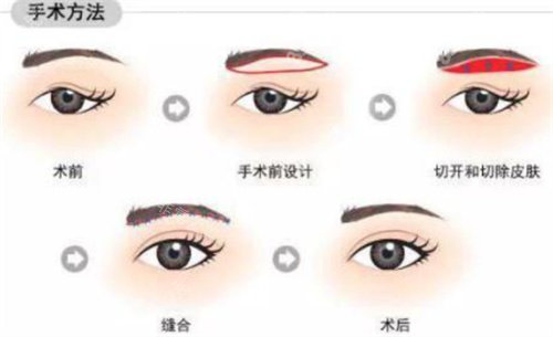 提眉术手术方法 提眉术手术方法