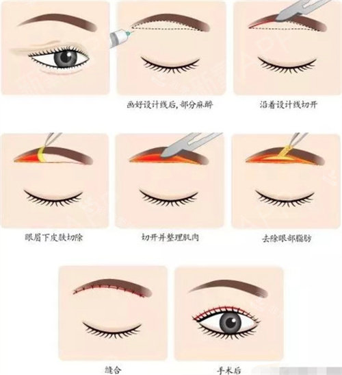 提眉术手术图 提眉术手术图