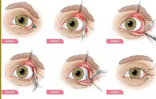 下眼睑外翻图