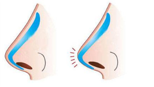 隆鼻前后鼻头对比图