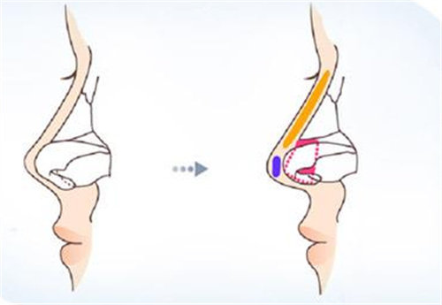 鼻部整形結(jié)構(gòu)展示圖