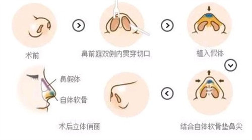 隆鼻手術方法流程圖 隆鼻手術方法流程圖