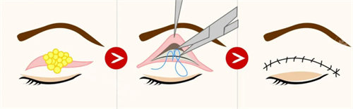全切双眼皮流程图