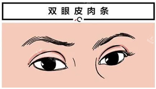 双眼皮肉条动画图 双眼皮肉条动画图