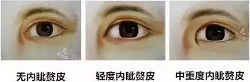 內(nèi)眥贅皮圖