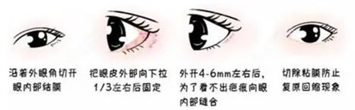 眼瞼下至手術(shù)圖