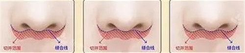人中手術(shù)圖 人中手術(shù)圖