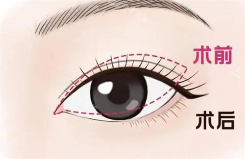 雙眼皮術(shù)前術(shù)后對(duì)比圖 雙眼皮術(shù)前術(shù)后對(duì)比圖