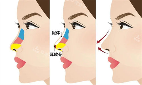 隆鼻結(jié)構(gòu)組織演示圖 隆鼻結(jié)構(gòu)組織演示圖