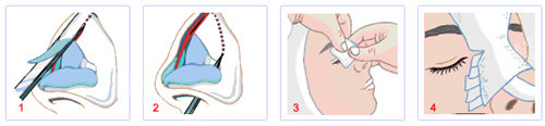 隆鼻手術(shù)流程圖