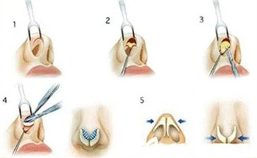 隆鼻手术图
