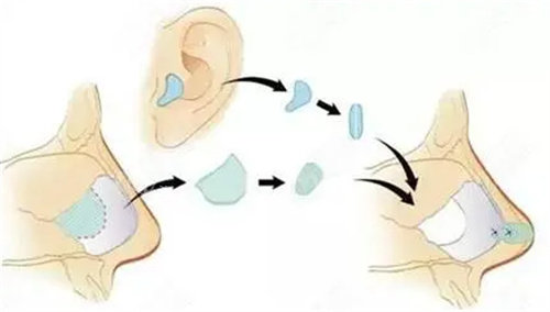 耳软骨隆鼻