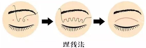 埋線雙眼皮圖 埋線雙眼皮圖
